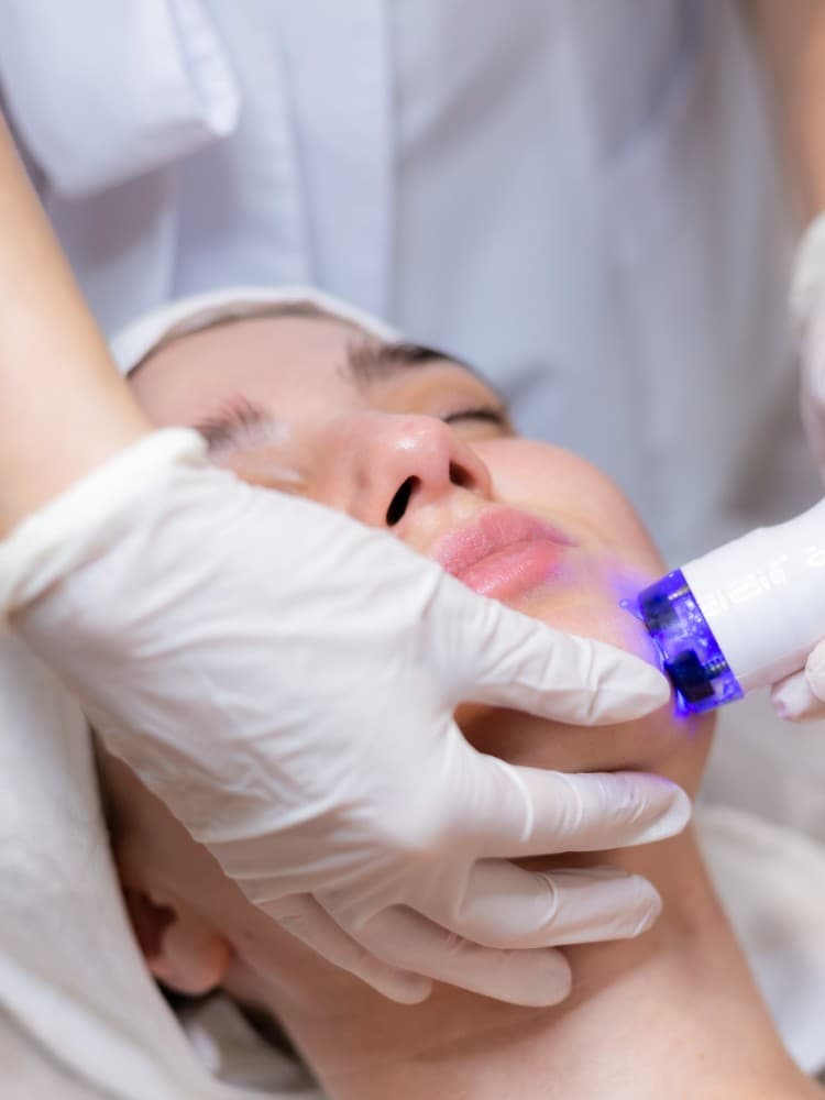 Laser for Acne Scars